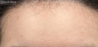 Forehead · MIRAJET + Rejuran + Exosome · before → 1 month