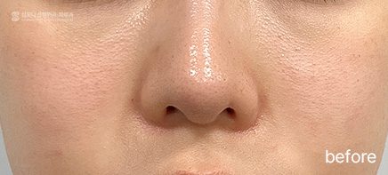 MIRAJET + Rejuran + Juvelook · before → after