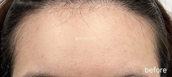 MIRAJET + Rejuran + Exosome · before → after