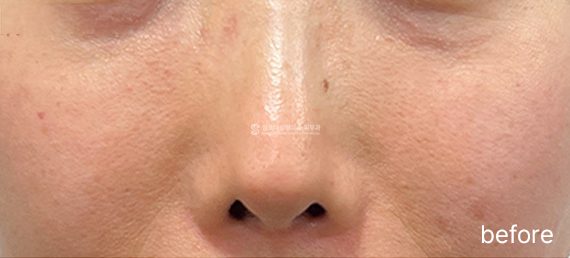 MIRAJET + Rejuran + Exosome · before → after