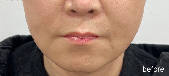 レディエッセ · 施術前 → 施術後
