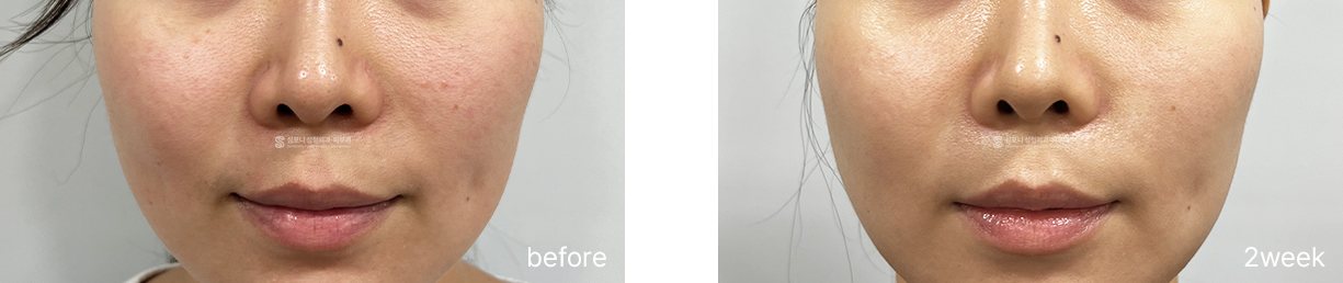 Overall tone and texture · before → 2 weeks