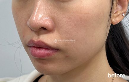 サーマクールFLX · 施術前 → 施術後