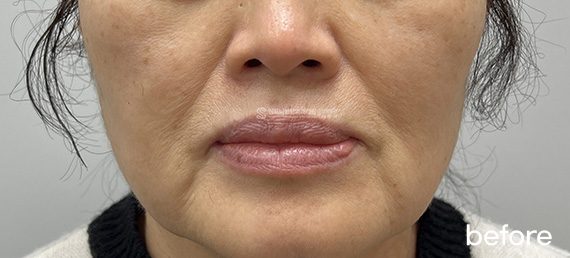 Sofwave + Thermage FLX + Radiesse · before → after