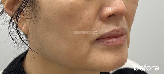 Sofwave + Thermage FLX + Radiesse · before → after