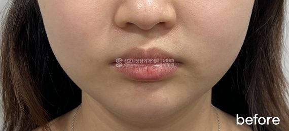 Double chin + Jawline · before → after