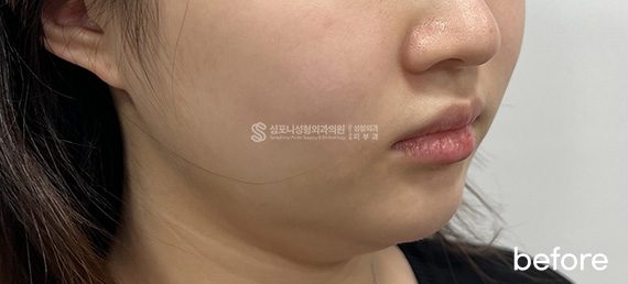 Double chin + Jawline · before → after