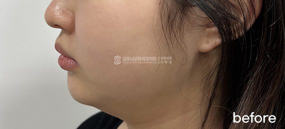 Double chin + Jawline · before → after