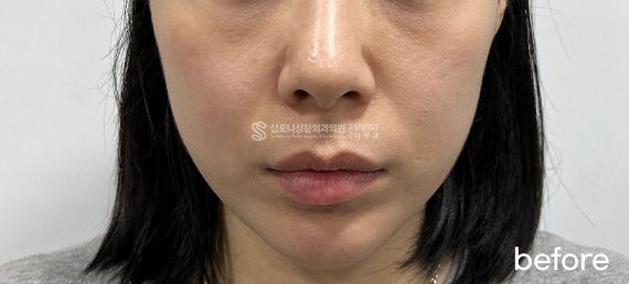 Double chin + Jawline · before → after