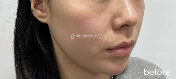 Double chin + Jawline · before → after