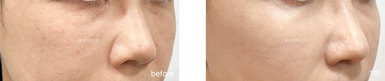 Cheek pigmentation · before → 1 session