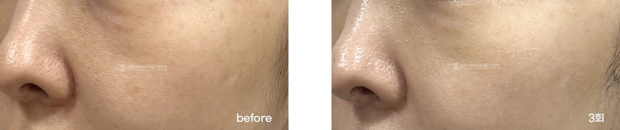 Cheek pores · before → 3 sessions