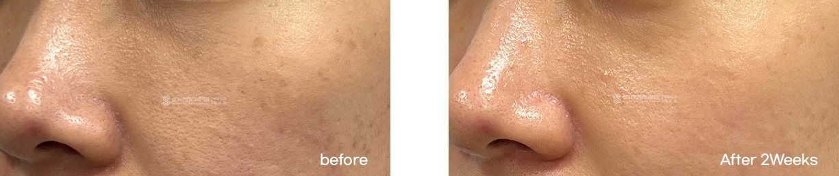 Pores and texture, nose and cheek · before → 2 weeks