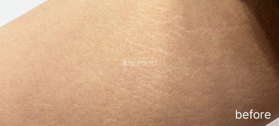 内もも · 施術前 → 施術後