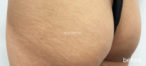 흉터 · 튼살 · 시술 전 → 후
