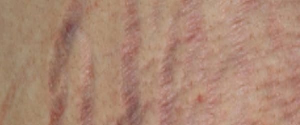 붉은 단계의 튼살 — 혈관 반응이 남아 있는 초기