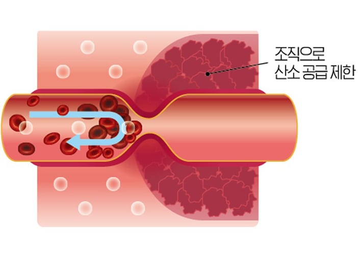 Impaired blood flow
