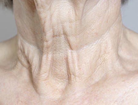 Vertical neck lines