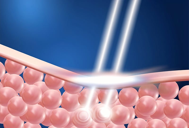 Conventional HIFU