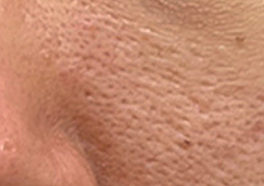 Scar-type pores