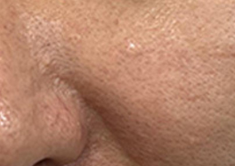 Excess-sebum type